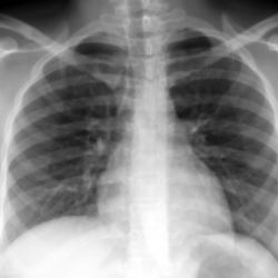 Chest X-rays don't prevent lung cancer, study says - Health & Wellness ...