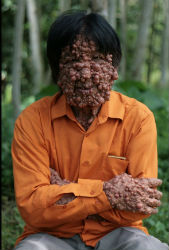 Indonesian man concentrates on curing bizarre skin disease to spare